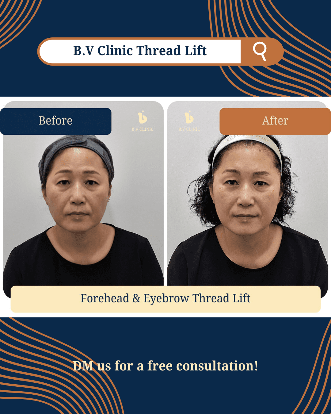 Forehead Thread Lift, Eyebrow Thread Lift