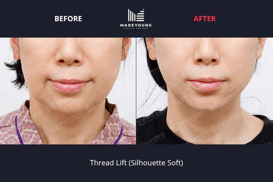 Before and After Thread Lift