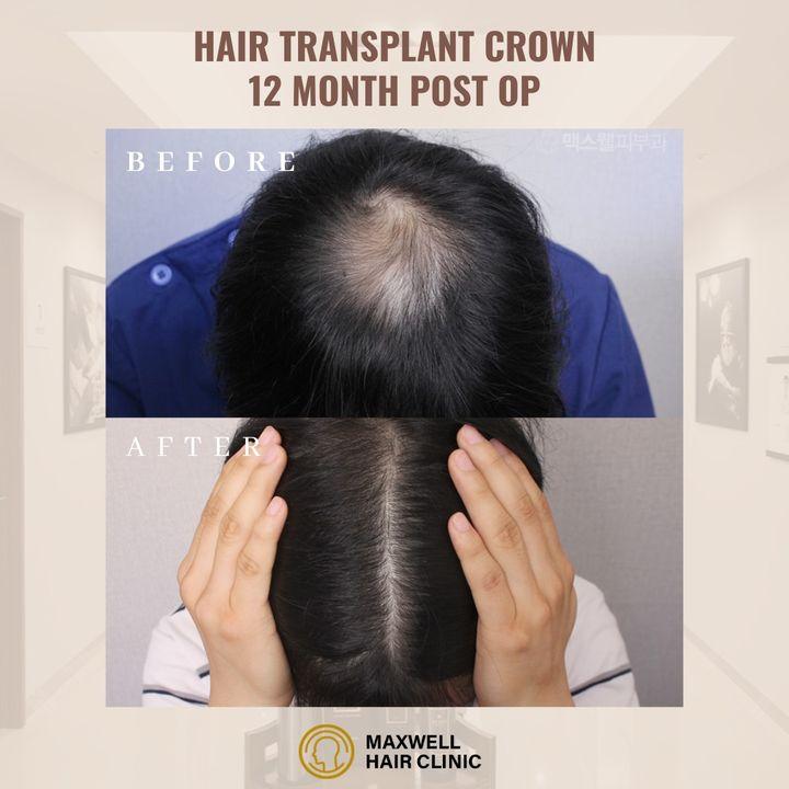 crown balding korea