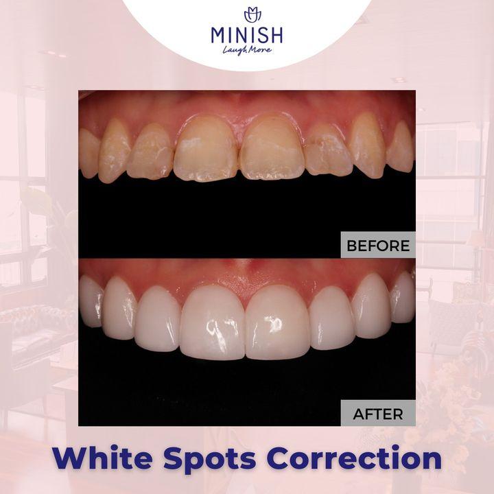 Even if you take great care of your teeth by brushing and flossing them twice a day and visiting the dentist frequently, white spots can still appear on your teeth. White spots can develop for a variety of reasons, such as an acidic or sugary diet, bad dental care, tooth trauma, and some medications. . 