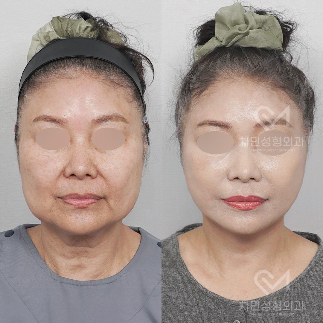 Before and After Face Lift