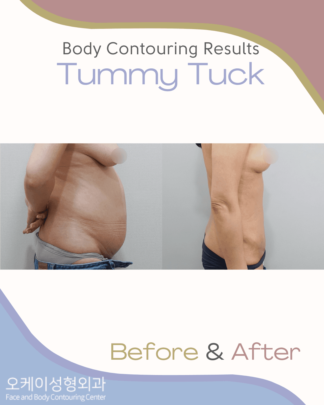 removal excess skin after weight loss korea
