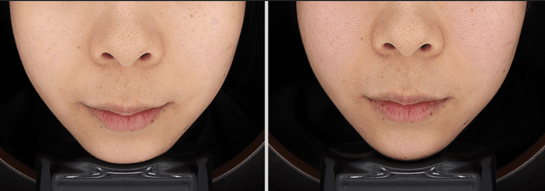 Before and After Chin Filler