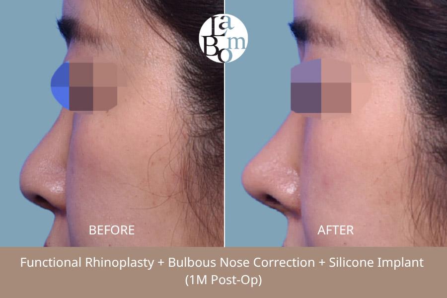 Before and After Rhinoplasty