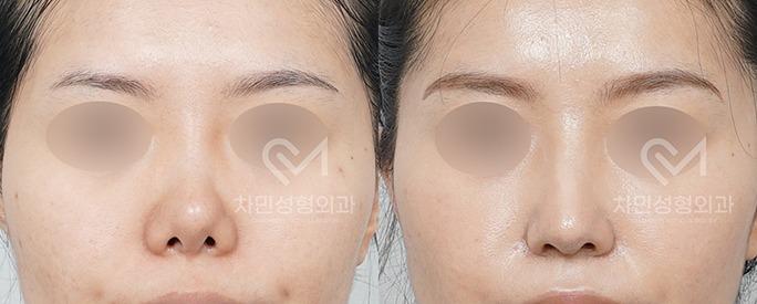 Before and After Rhinoplasty