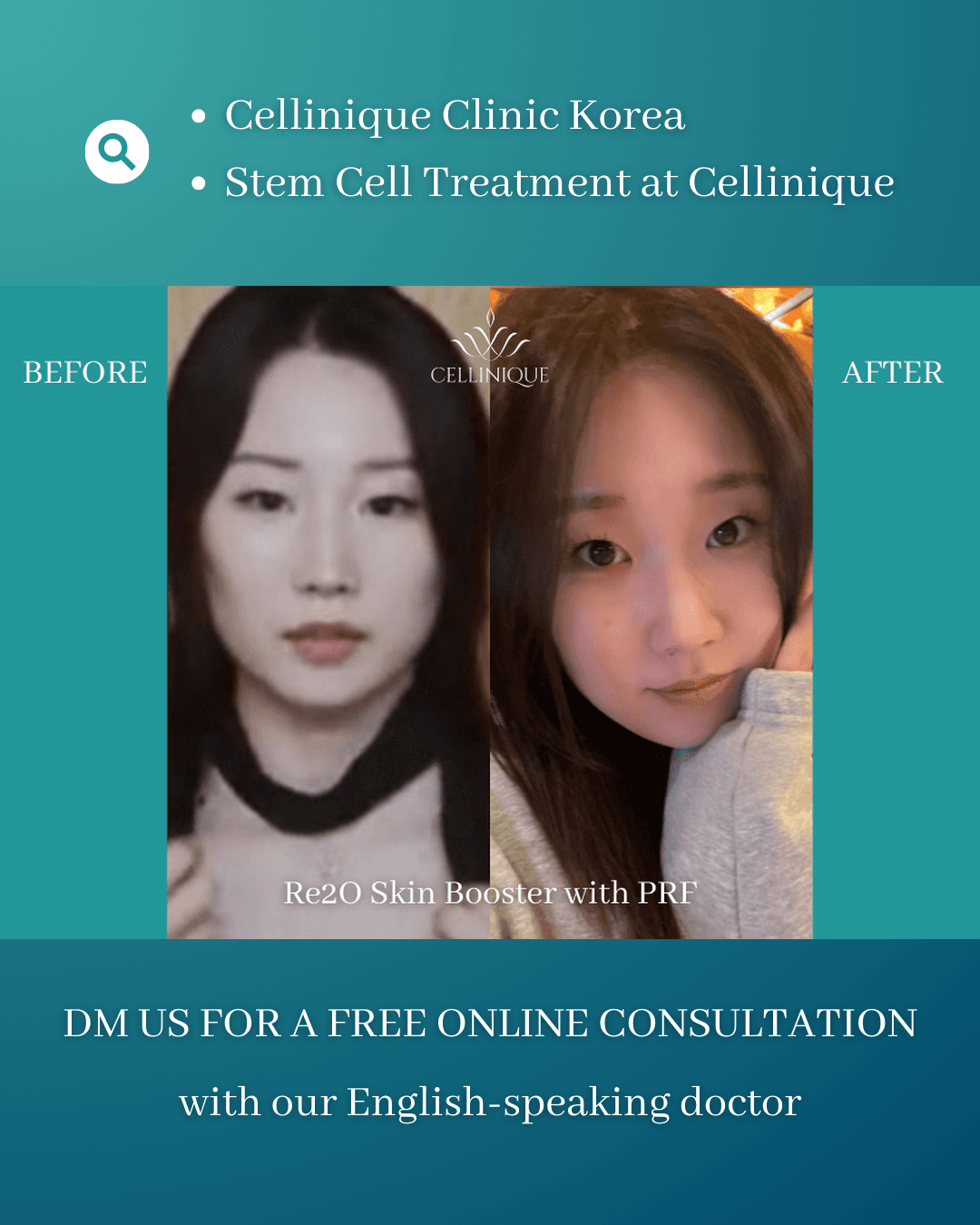 Re2O Skin Booster, PRF-Injektion, Skin Booster