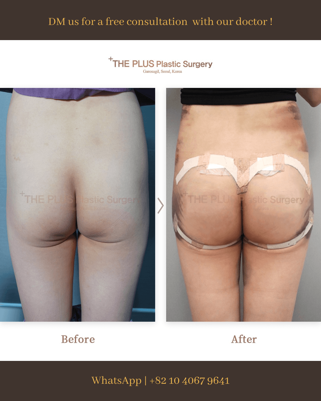 Butt Thread Lift, Brazilian Butt Lift