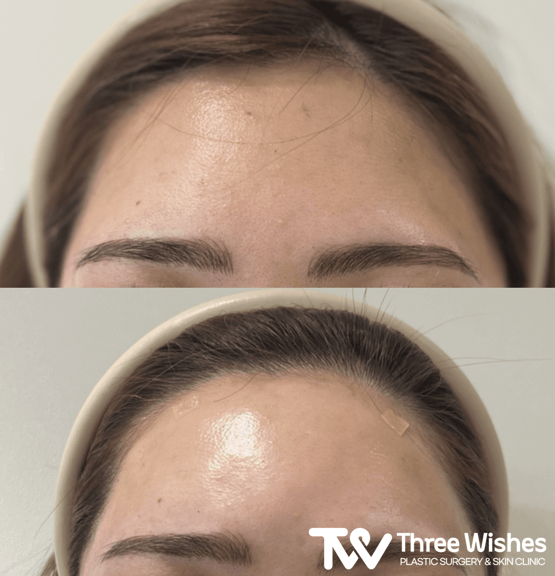 Vorher-Nachher-Bild der Three Wishes Clinic - Myeongdong