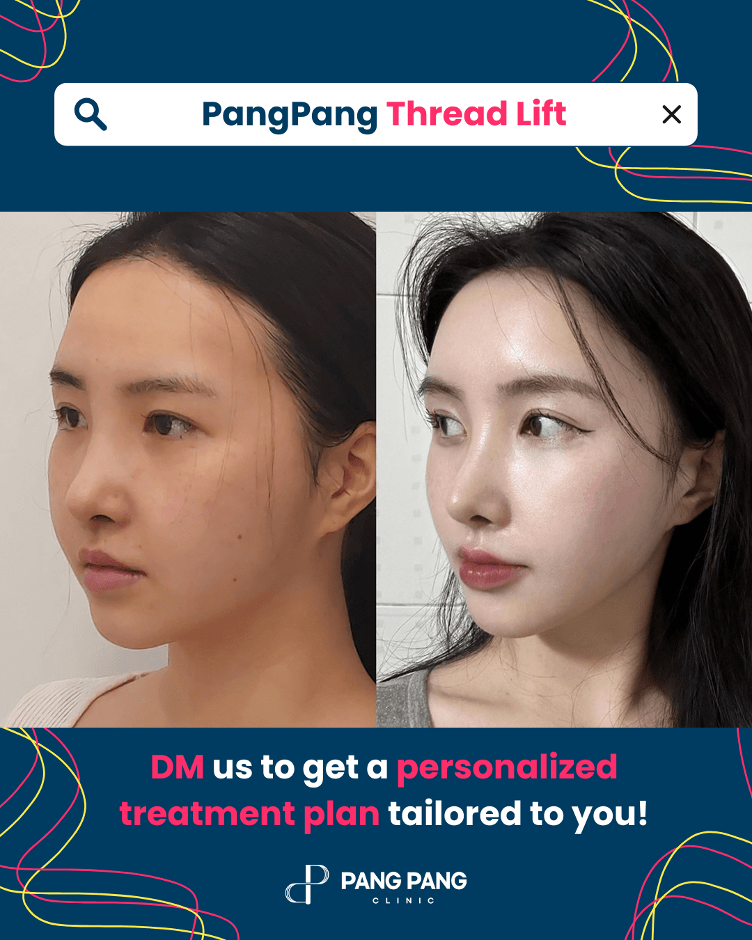 Thread Lift, Eyebrow Thread Lift, Forehead Thread Lift