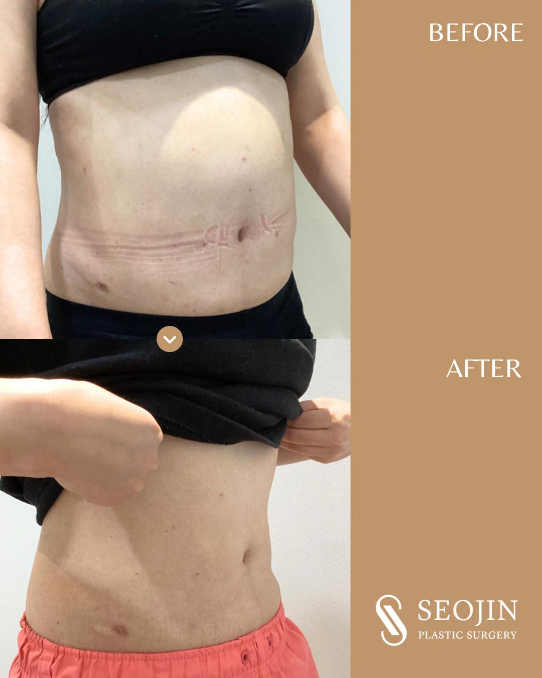 Abdominale Liposuktion
