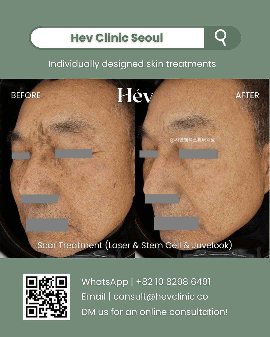 Scar Removal Laser, Stem Cell Facial