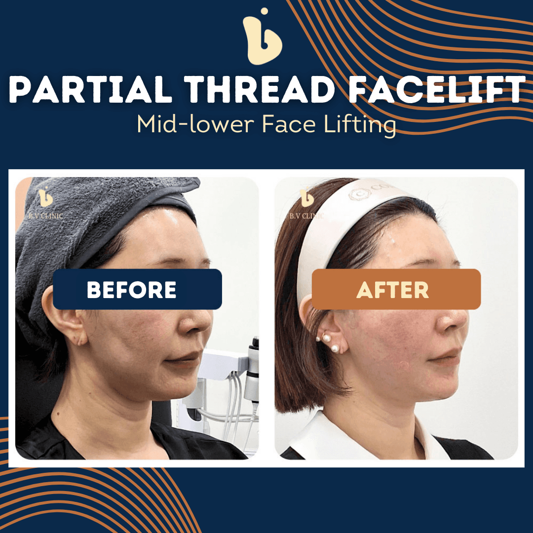 B.V Clinic before and after image