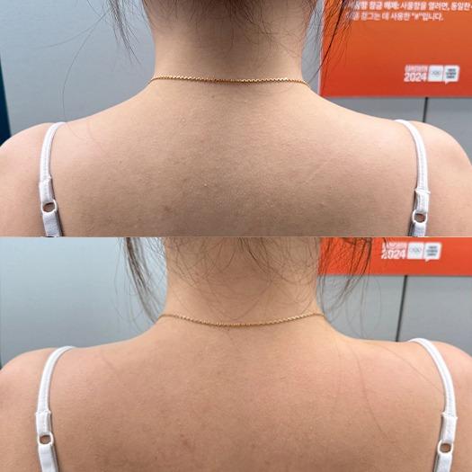 Before and After Fat Dissolving Injection