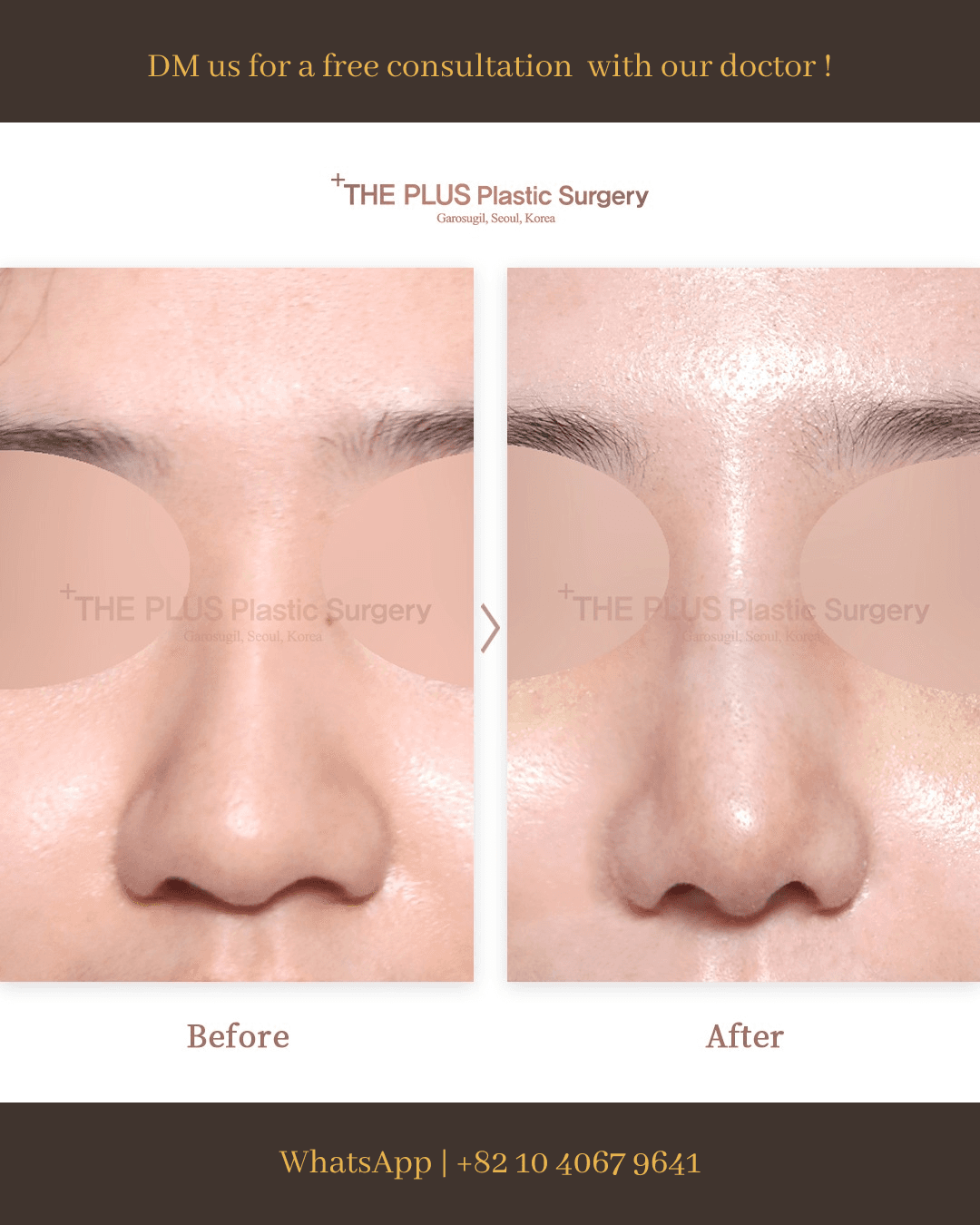 Rhinoplasty, Nose Osteotomy, Nose Implant