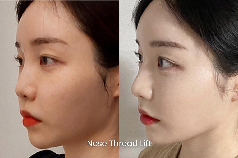 Before and After Nose Thread Lift