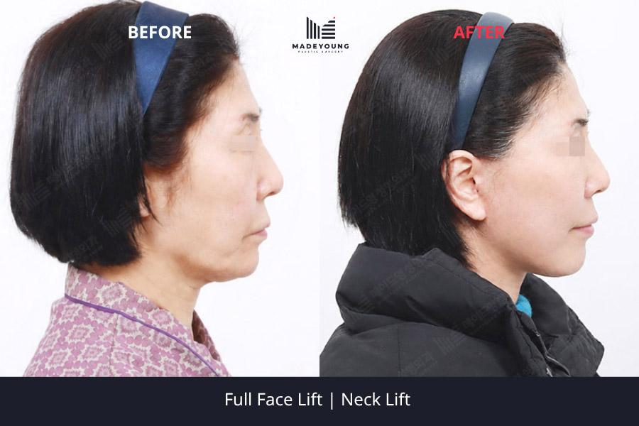 Face lift neck lift