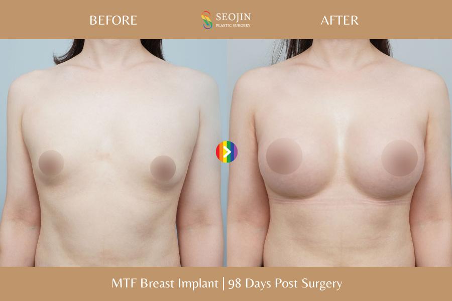 Seojin Plastic Surgery Clinic before and after image