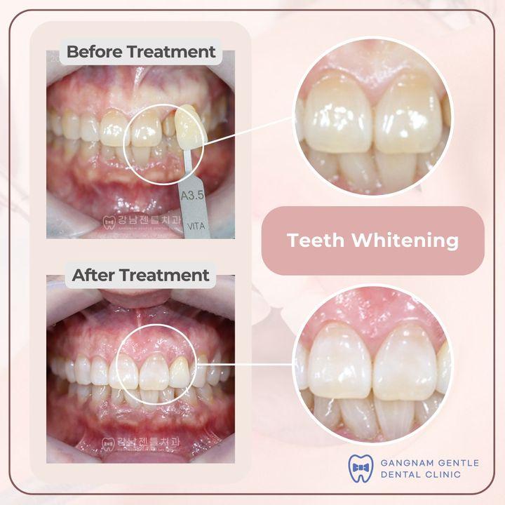 Brighten your smile with our professional teeth whitening services. See the clear difference in our before and after photos.