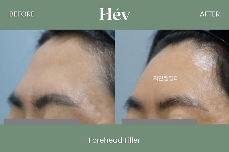 Forehead Filler