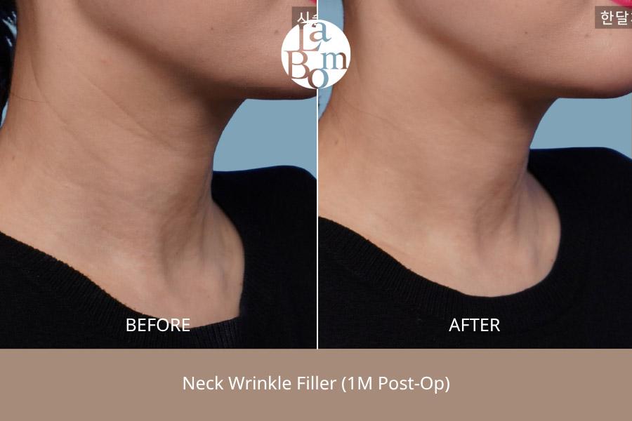 Before and After Neck Wrinkle Treatment