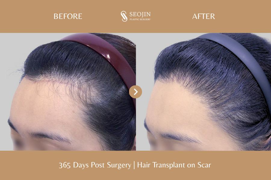 Seojin Plastic Surgery Clinic before and after image
