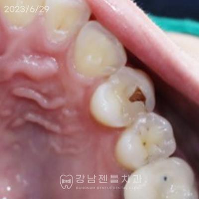 Before Teeth Crown