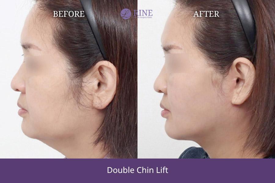 Double Chin lift