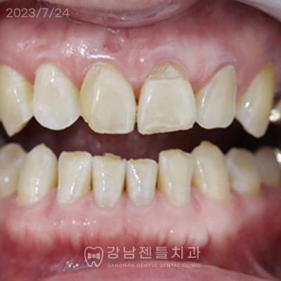 Gentle Veneer