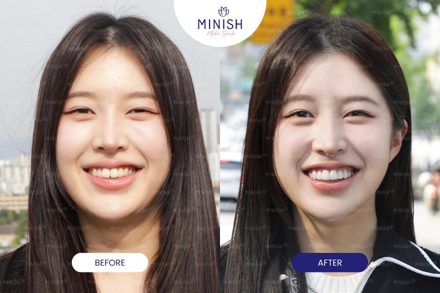 Before and After Veneers