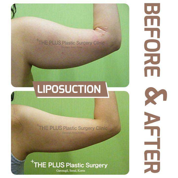 What is Liposuction❓ Another critical aspect of achieving the desired body contour is liposuction. THE PLUS liposuction procedure focuses on refining the body’s contours by carefully extracting fat from specific areas, rather than removing large volumes of fat. This approach helps maintain a balanced and well-defined body shape.  To get best Liposuction services book an appointment today for consulting a doctor.