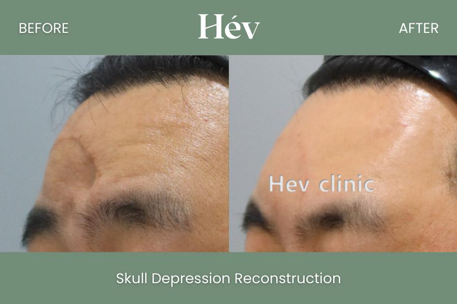 Hev Skull Depression Reconstruction