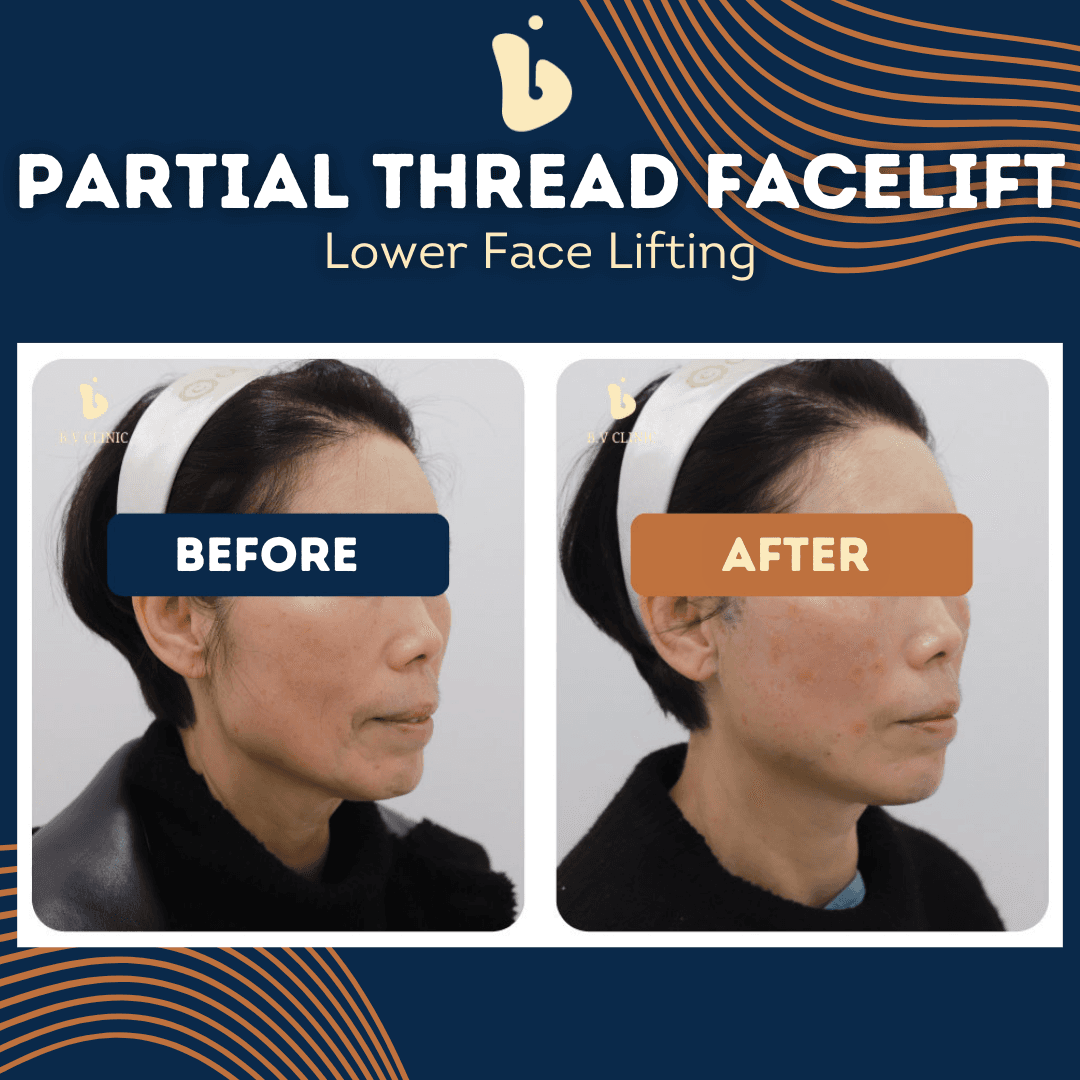 B.V Clinic before and after image