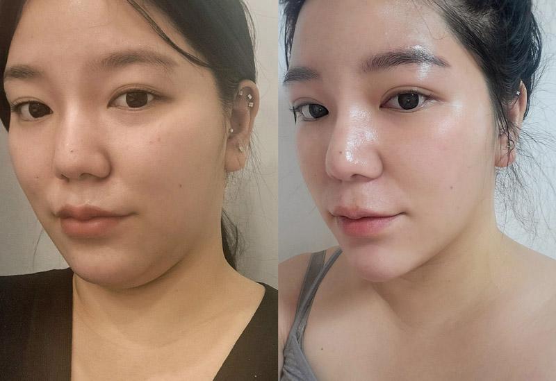 Before and After Face Thread Lift