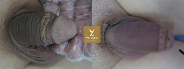 Before and After Glans Enlargement