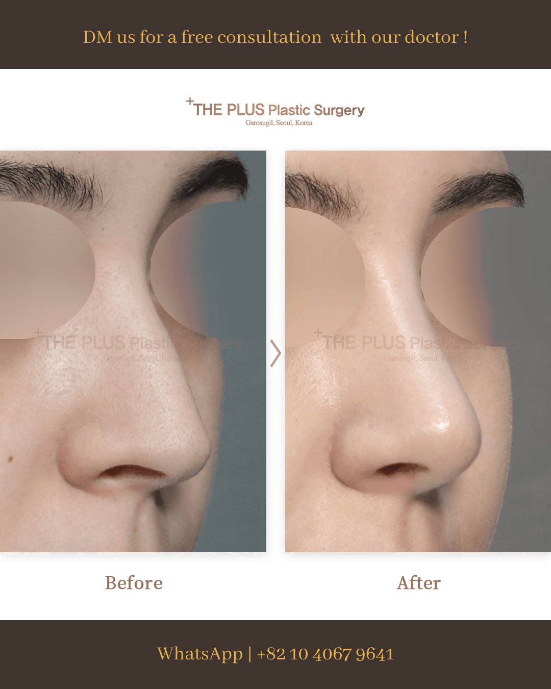 Rhinoplasty, Nose Osteotomy