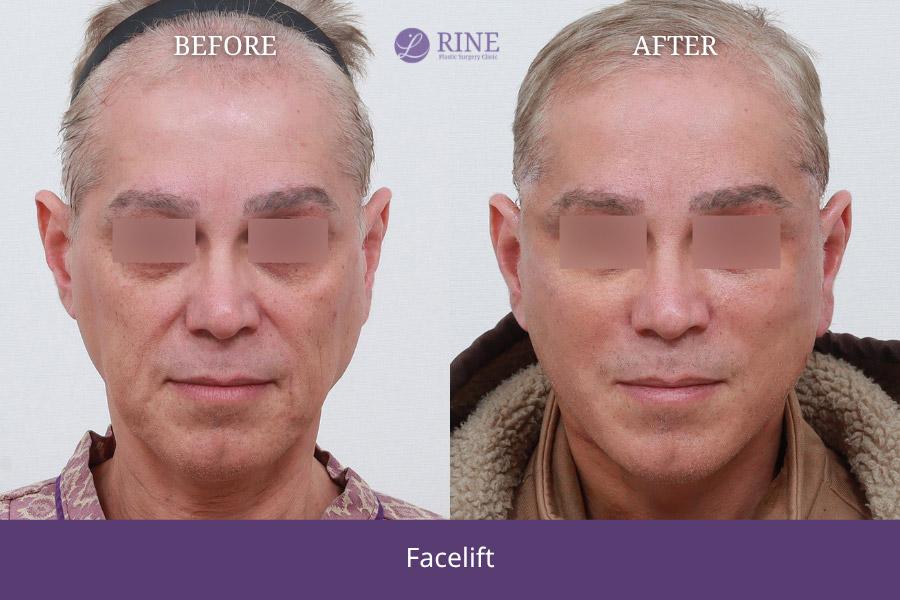 Before and After Face Lift