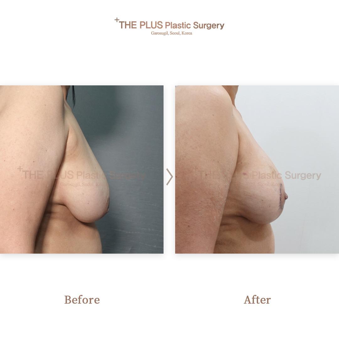 ThePlus Breast Lift & Inverted Nipple Surgery & Breast Fat Grafting