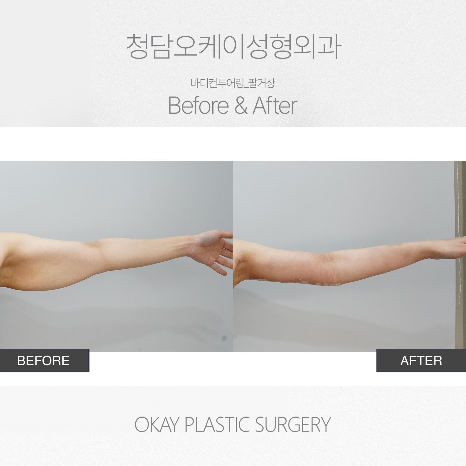 Okay Plastic Surgery Clinic before and after image