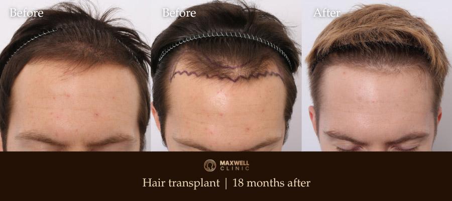 Male frontal