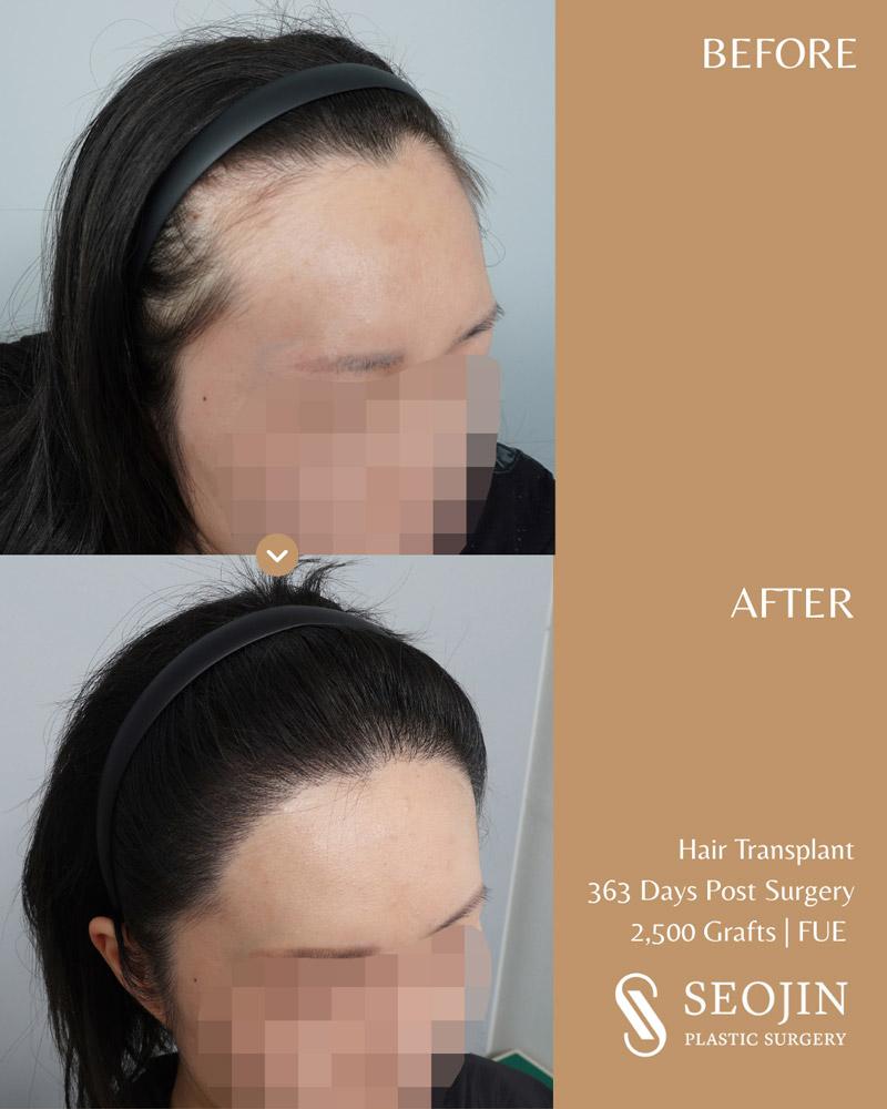 Hairline Correction