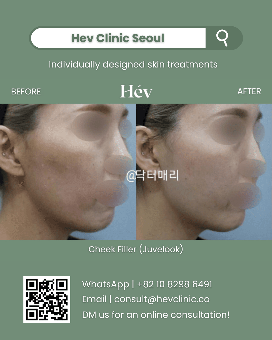Facial Filler, Juvelook Volume Filler