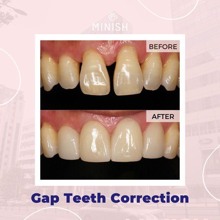 While some individuals embrace their gap teeth as a unique feature, others may feel self-conscious about it. Fortunately, there are several treatment options available for addressing gap teeth, depending on the cause and severity.