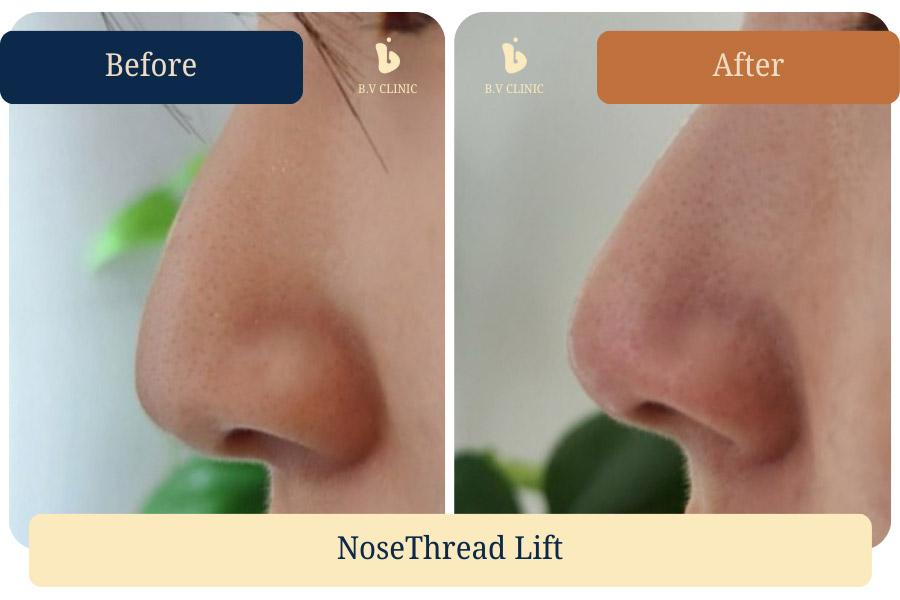 Before and After Nose Thread Lift
