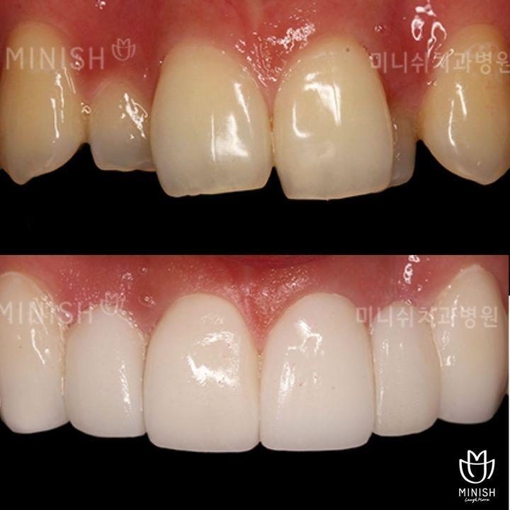 gum hyperpigmentation korea