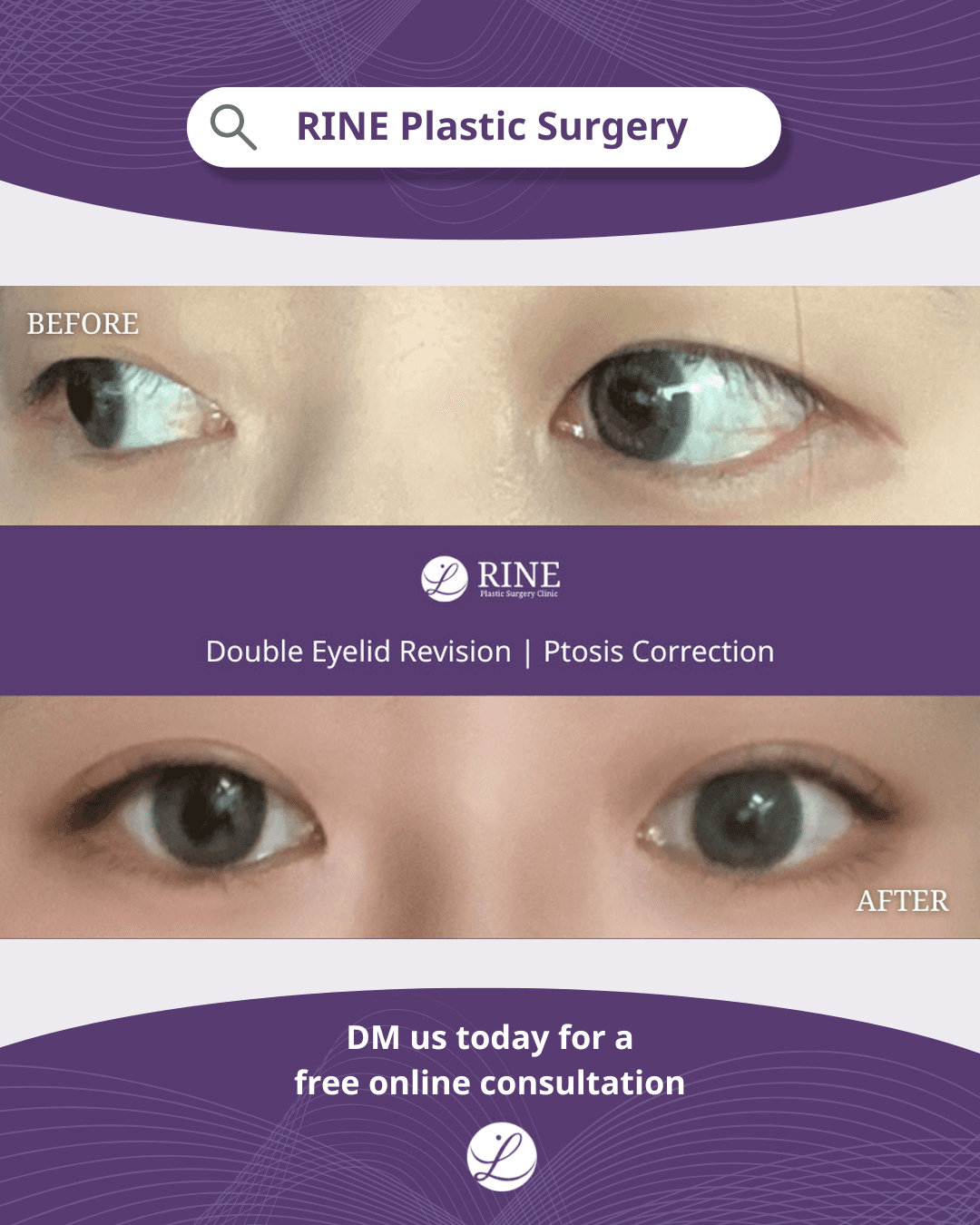 Revision Eye Surgery, Double Eyelid Surgery, Ptosis Correction