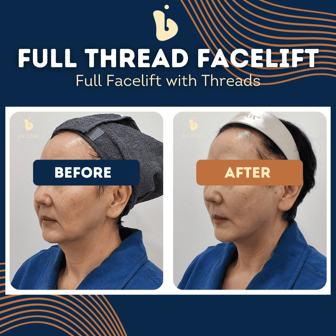 face thread lift korea