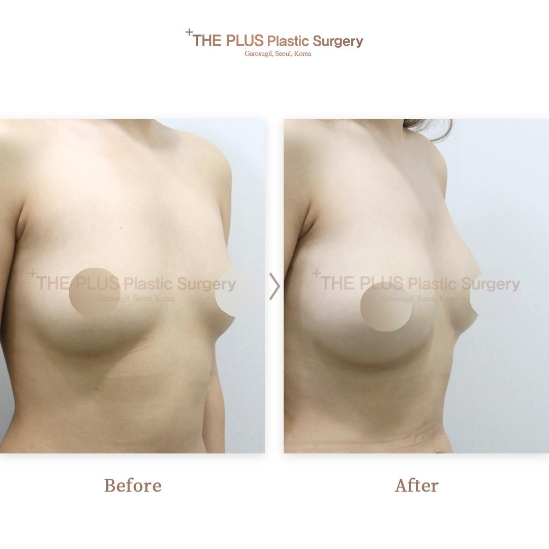 Breast augmentation by autologous fat grafting