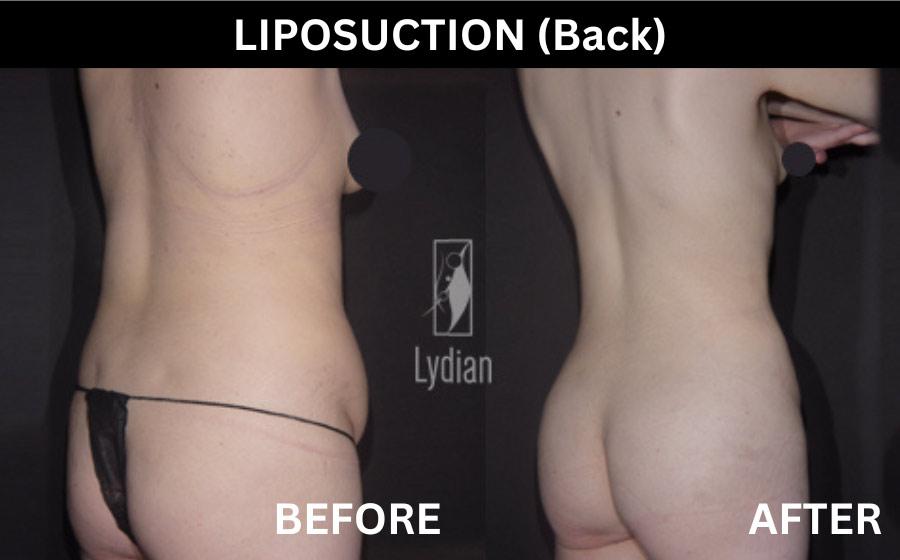 Lydian Plastic Surgery Clinic before and after image