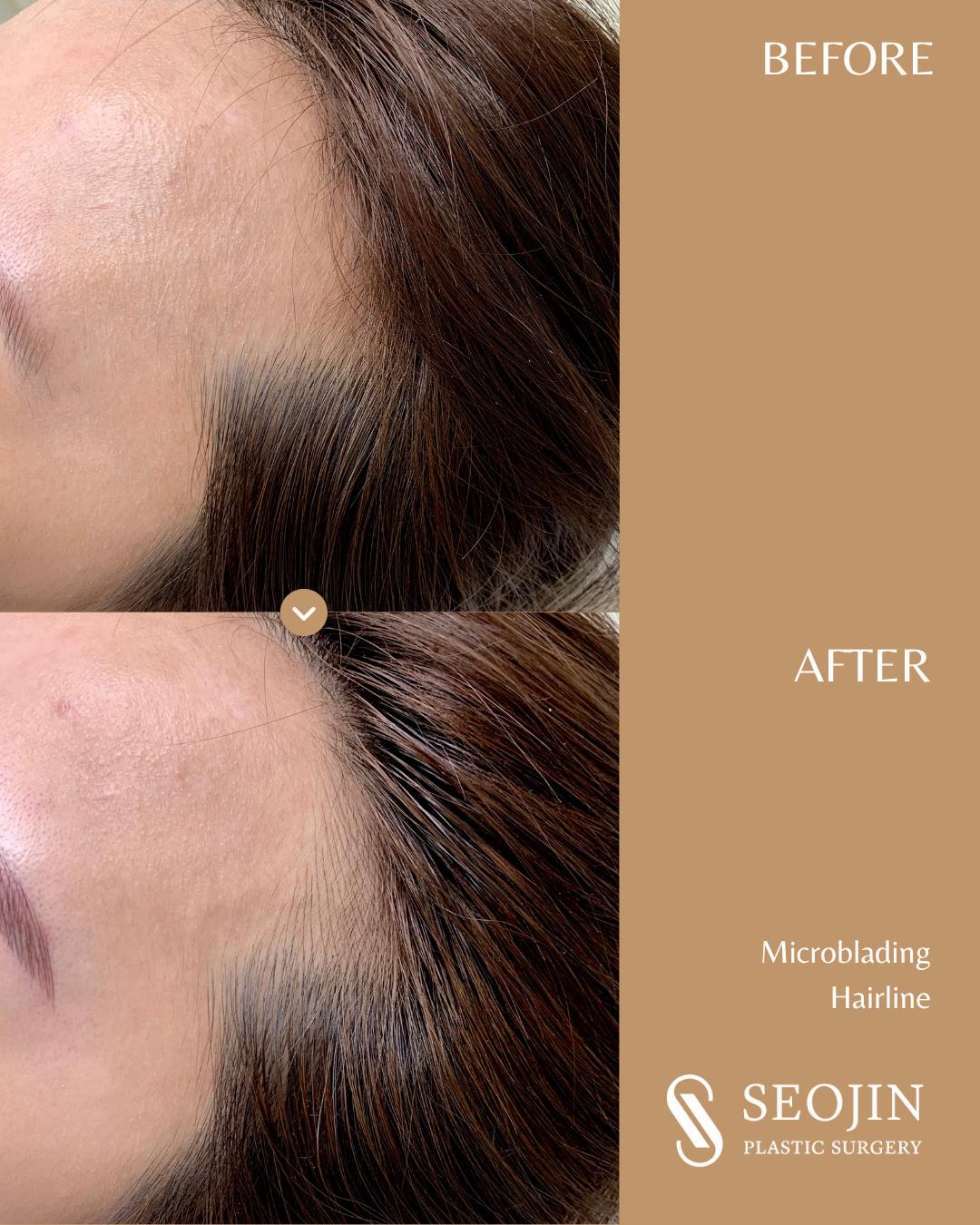seojin-microblading-hairline-1 