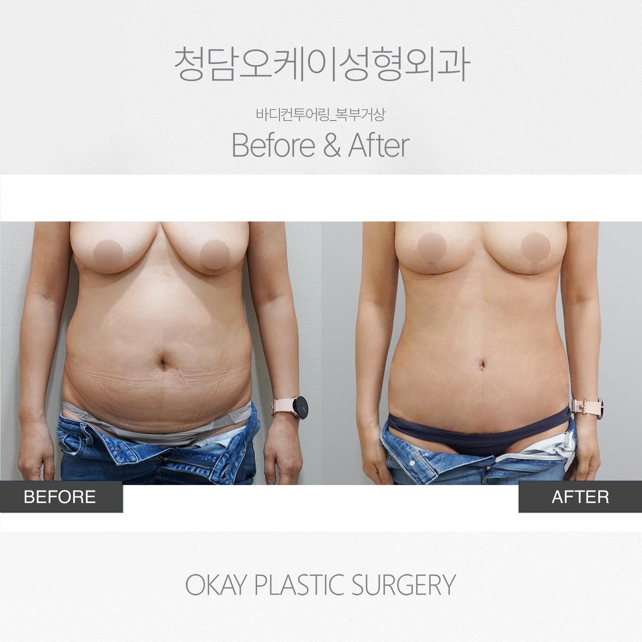 Before and After Tummy Tuck